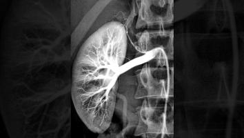 Röntgenfoto van een nier