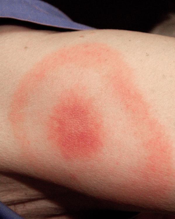erythema migrans