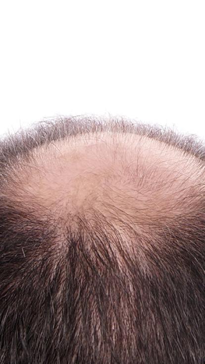 man met kale kruin bovenop het hoofd