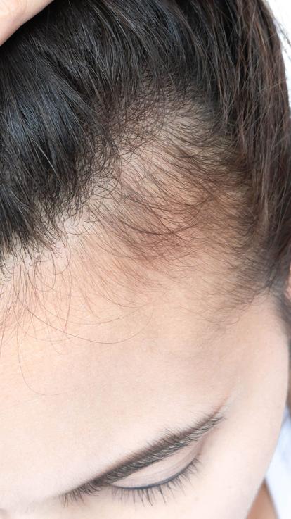 vrouwe trekt haar naar achter en laat plekken met dunner haar zien