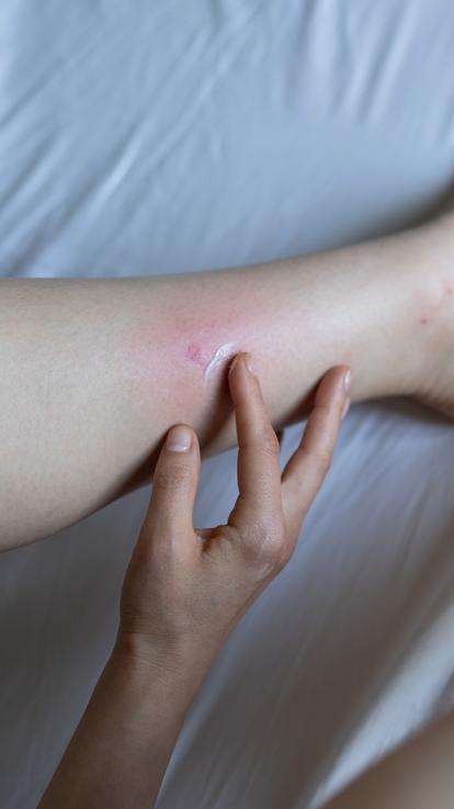 Iemand smeert een witte crème op een rode muggenbult op haar been
