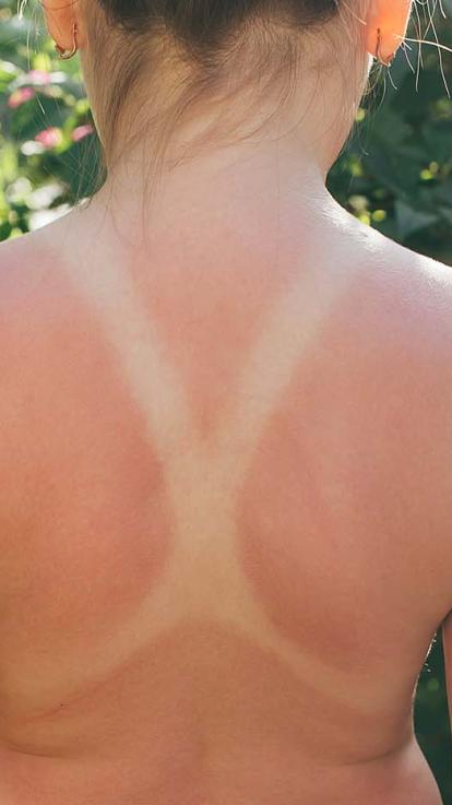 verbrand door de zon