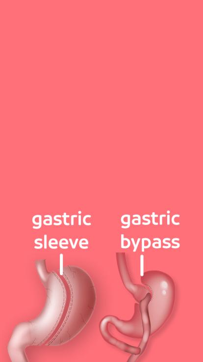 het verschil tussen gastric sleeve en gastric bypass
