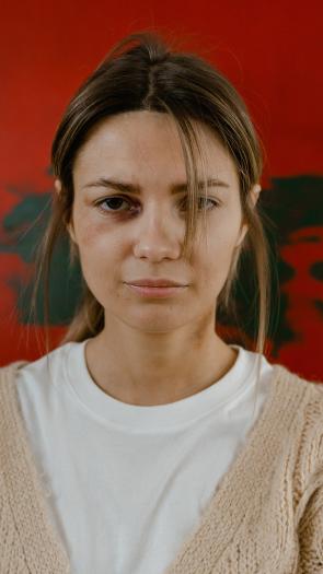 een vrouw met een blauw oog kijkt recht in de camera