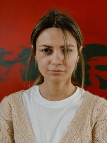 een vrouw met een blauw oog kijkt recht in de camera