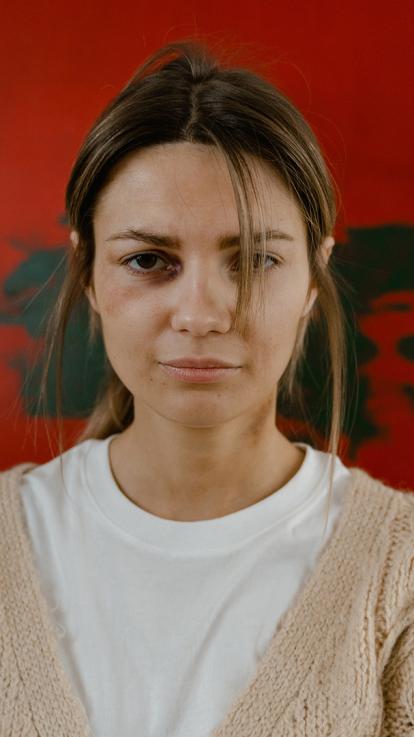 een vrouw met een blauw oog kijkt recht in de camera