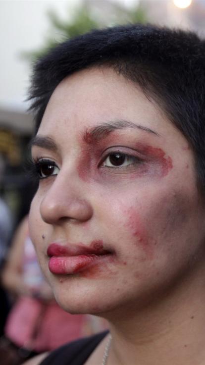 een vrouw met gezichtsverwondingen bij een protest tegen femicide