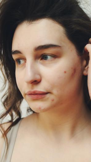 Iemand met acne, ofwel puistjes, op d'r wang en kin