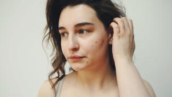 Iemand met acne, ofwel puistjes, op d'r wang en kin