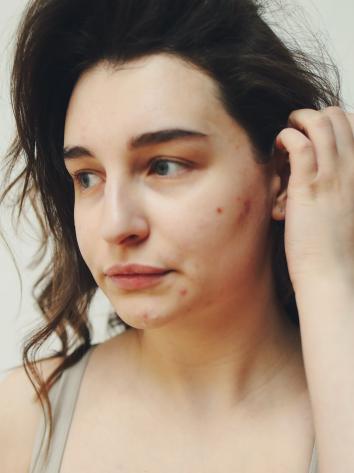 Iemand met acne, ofwel puistjes, op d'r wang en kin