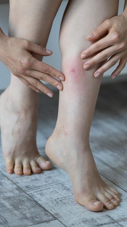 een beschadigde muggenbult op iemands been