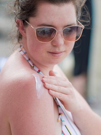 iemand is verbrand en smeert zichzelf in met crème