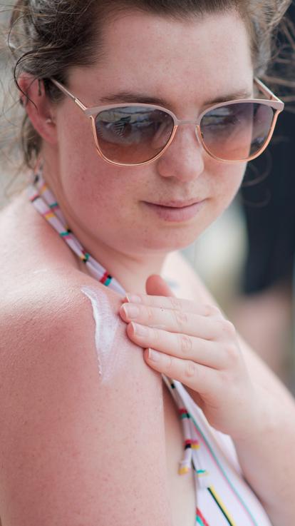 iemand is verbrand en smeert zichzelf in met crème