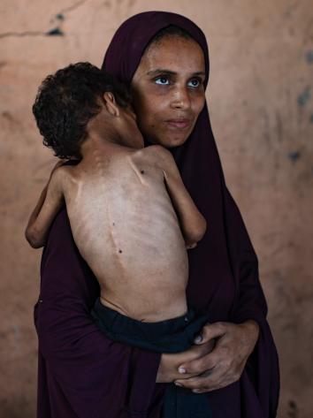 een vrouw houdt haar ondervoede kind in haar armen