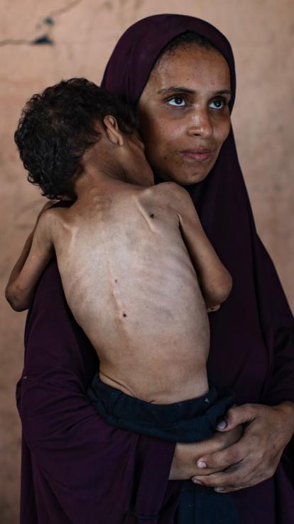 een vrouw houdt haar ondervoede kind in haar armen