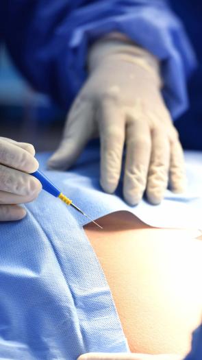 We zien de handen van een arts met een injectienaald in zijn hand, klaar om iemand te injecteren met een ruggenprik.