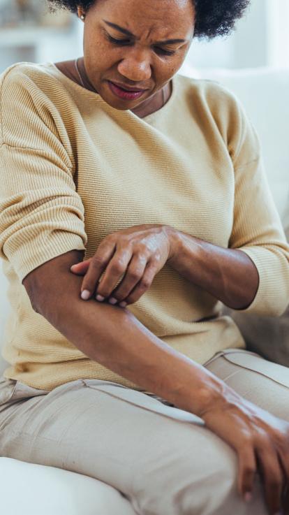 Een vrouw krabt aan een muggenbult op haar arm