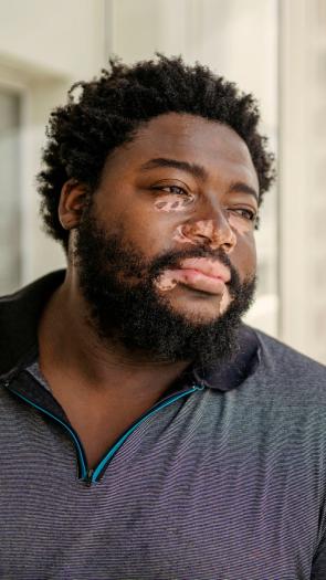 Een man met vitiligo kijkt uit het raam 