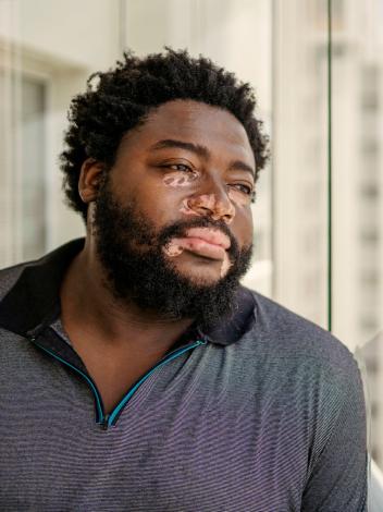 Een man met vitiligo kijkt uit het raam