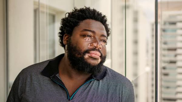 Een man met vitiligo kijkt uit het raam
