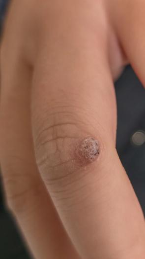 Een close-up van iemands vingers; op 1 vinger zit een wrat op de knokkel