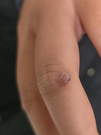 Een close-up van iemands vingers; op 1 vinger zit een wrat op de knokkel