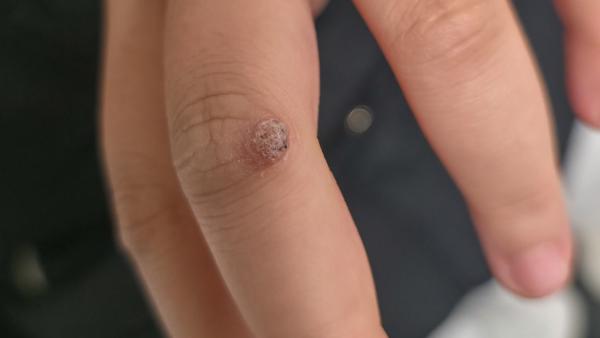 Een close-up van iemands vingers; op 1 vinger zit een wrat op de knokkel